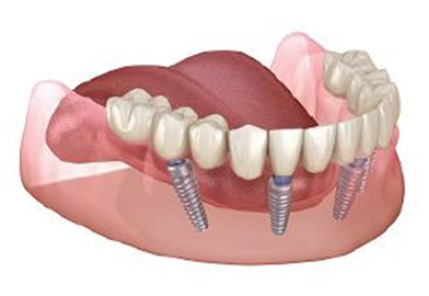 Teeth in a Day (All-on-4 / All-on-6)