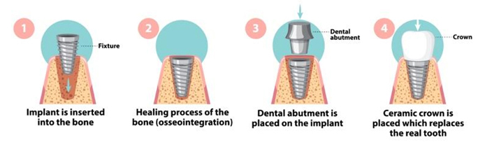 Implant procedure