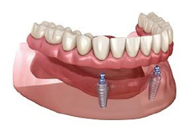 Overdenture (Implant-Supported Denture)