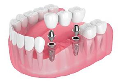 Implant Bridge