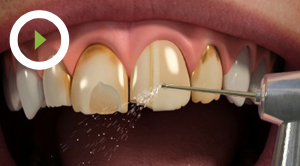 Composite Veneers